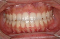 歯列矯正4
