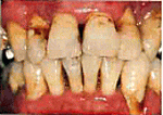 歯周病治療5