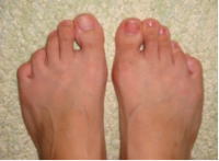 足指変形