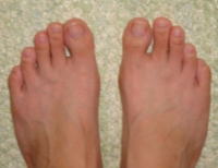足指矯正
