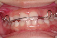 歯列矯正9