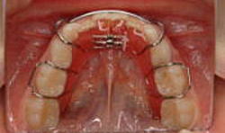 歯列矯正11