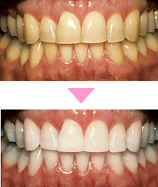 ホワイトニング2
