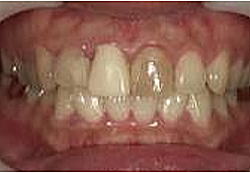 ホワイトニング3